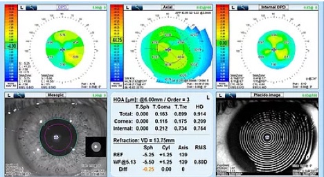 Nidek Scan example