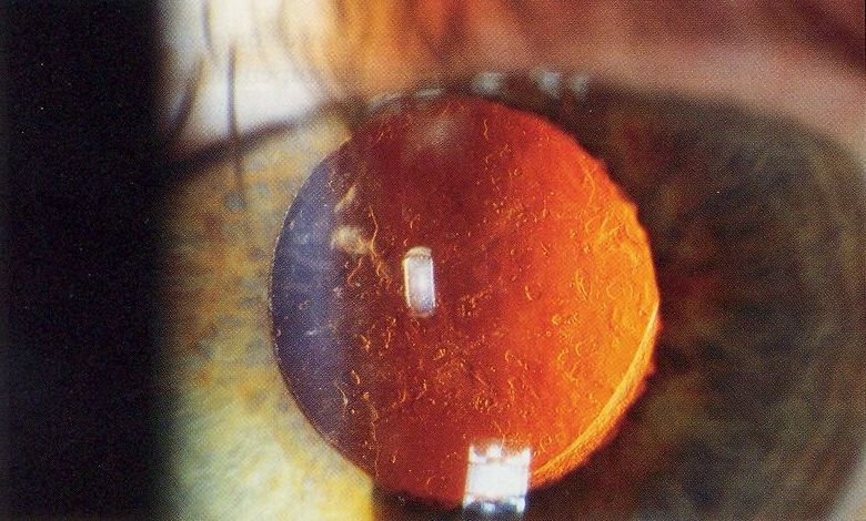 Posterior capsular opacification YAG laser